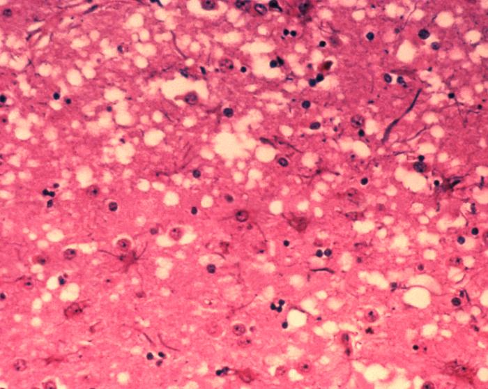 Auch die "Rinderseuche" BSE wird von Prionen verursacht. Unter dem Mikroskop sieht man, dass die Infektion das Gehirn durchlöchert wie einen Schwamm. (Foto: Dr. Al Jenny via Wikimedia Commons)